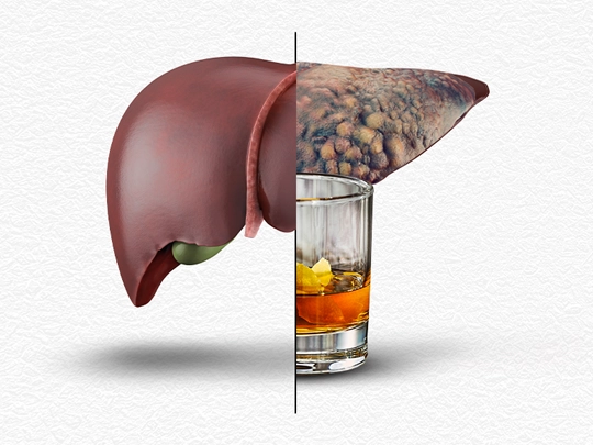 Alkol karaciğerde yağlanma yapar mı?