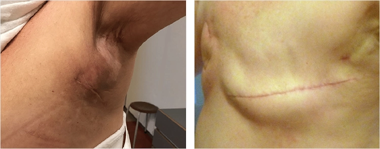 Meme Kanseri Ameliyatı Koltuk Altı