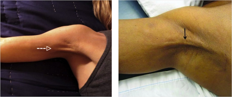 Meme Kanseri Ameliyatı Riskleri