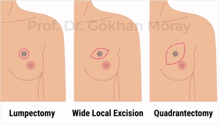 Meme Koruyucu Cerrahi