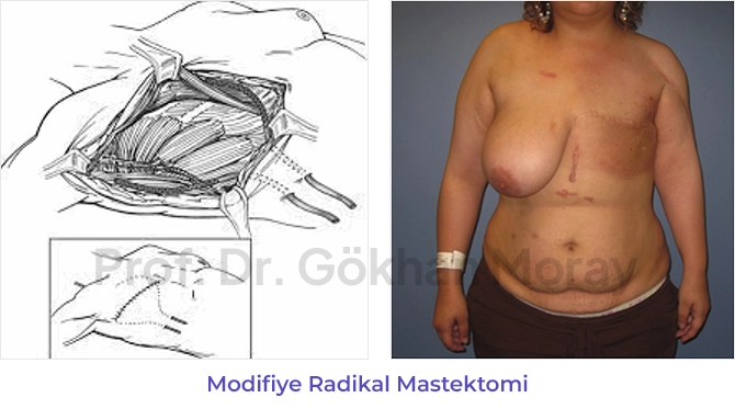 Modifiye Radikal Mastektomi