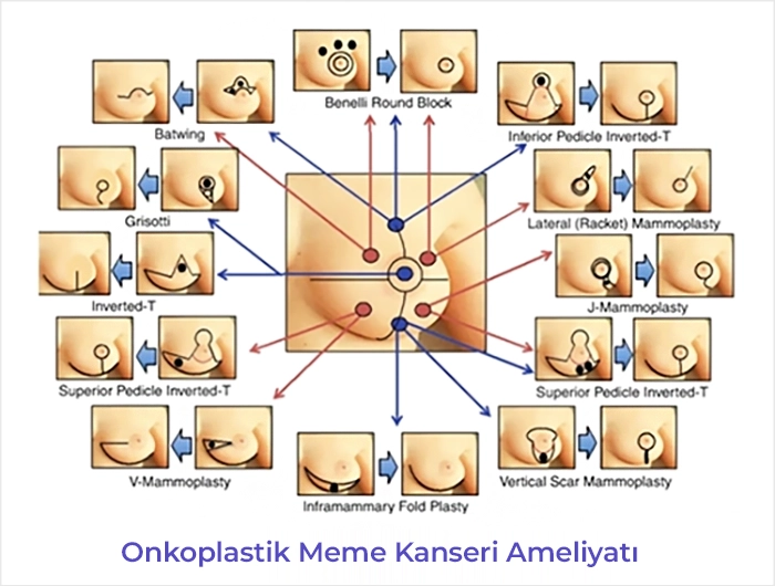 Onkoplastik Meme Kanseri Ameliyatı