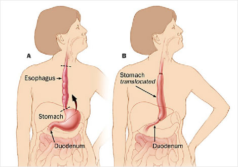 Transhiatal Ozefajektomi ve Gastrik Interpozisyon
